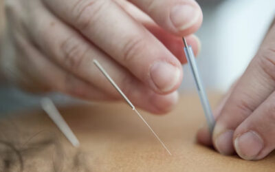 Dry Needling as a Treatment Technique